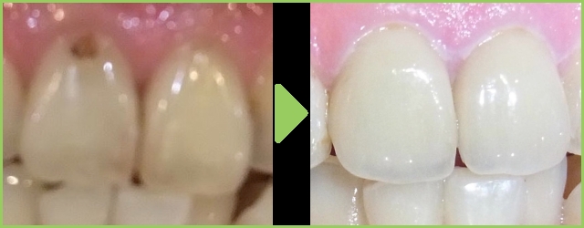 白い詰め物・被せ物で治療した歯を目立たないように
