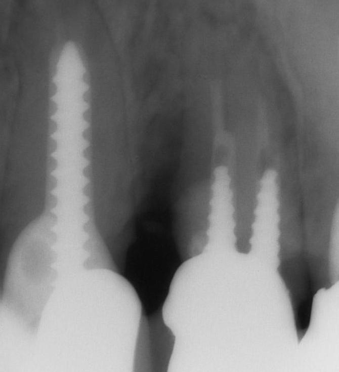 当グループの歯槽骨再生療法(エムドゲイン療法)