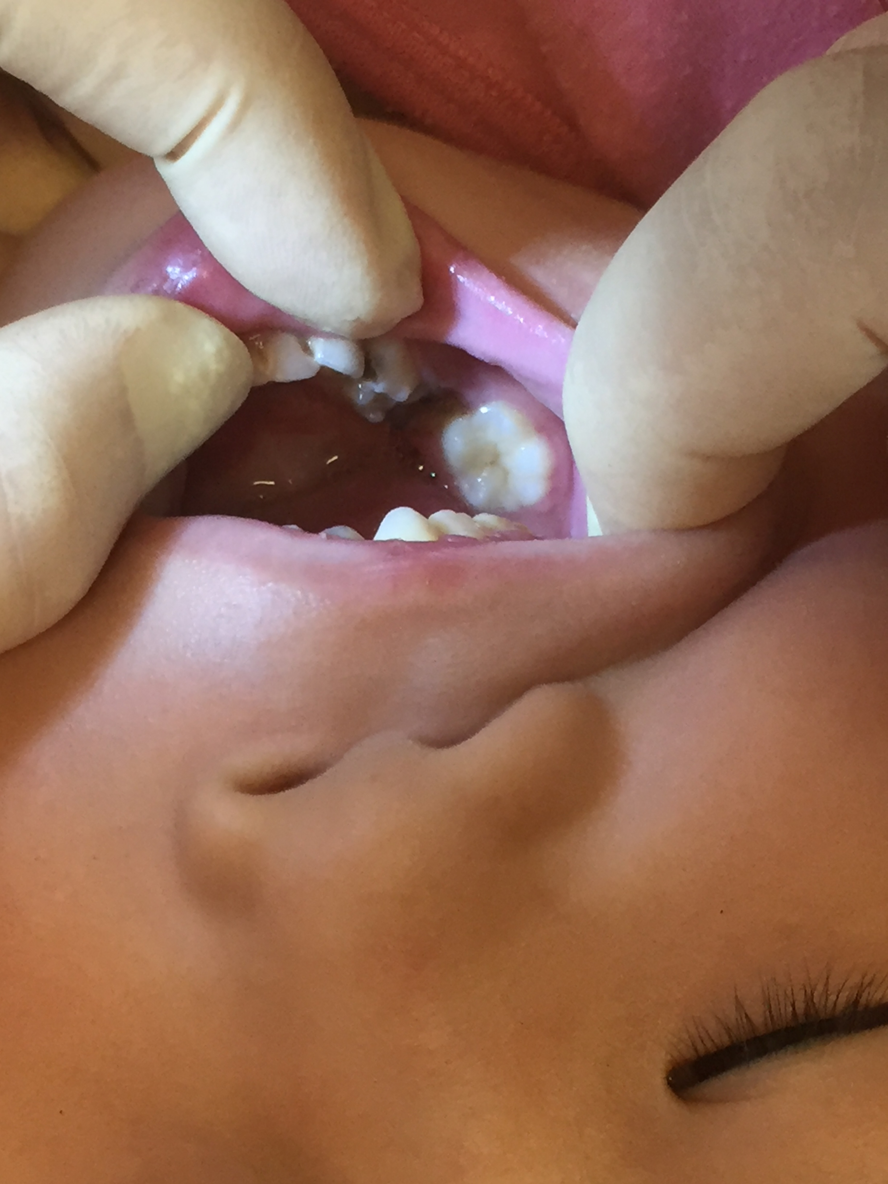 前歯乳歯の虫歯